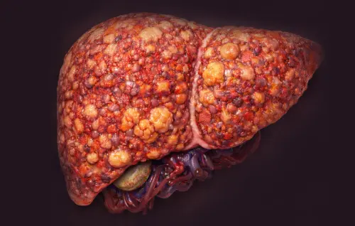 Alcohol Associated Liver Disease)