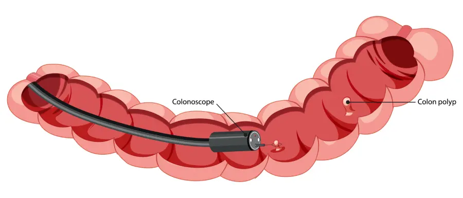 Minimally Invasive Endoscopic Procedure: An Overview