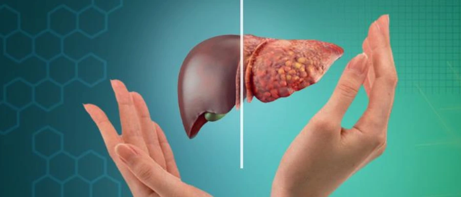 Fatty Liver Treatment in Kolkata, Dr Abhishek Banerjee