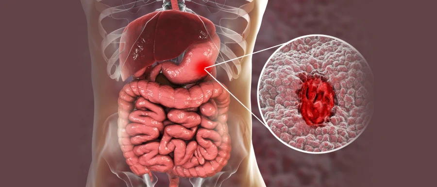 Gastrointestinal Polyps Treatment in Kolkata