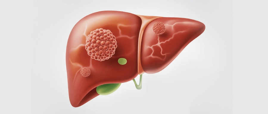 Hepatitis Treatment in Kolkata, Dr Abhishek Banerjee