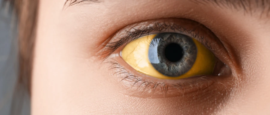 Jaundice Treatment in Kolkata, Dr Abhishek Banerjee